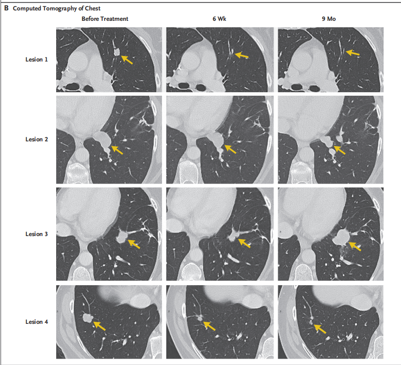 圖2?患者轉移病灶的變化情況 圖2?患者轉移病灶的變化情況