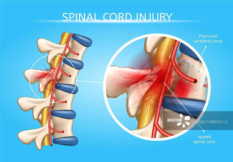 神經干細胞移植在脊髓損傷修復中的作用及應用