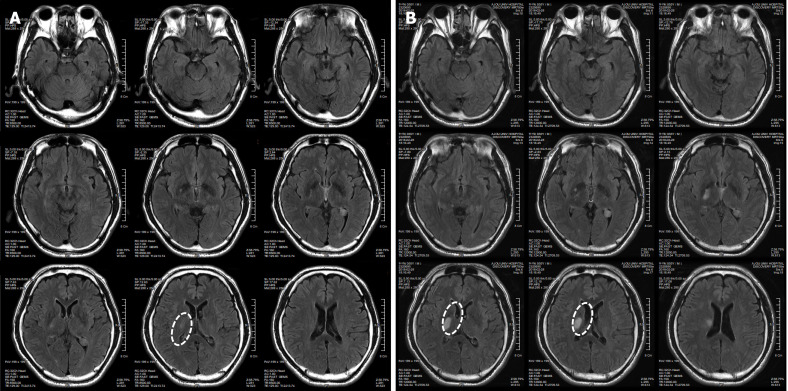 圖1：微創人臍帶間充質干細胞移植前患者的腦部計算機斷層掃描圖像。