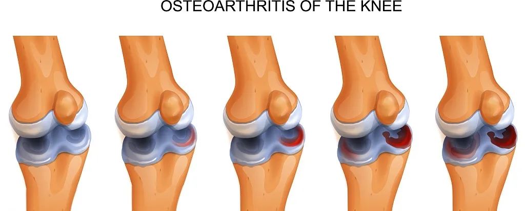 國內(nèi)外臨床研究表明：干細(xì)胞修復(fù)半月板損傷更具優(yōu)勢