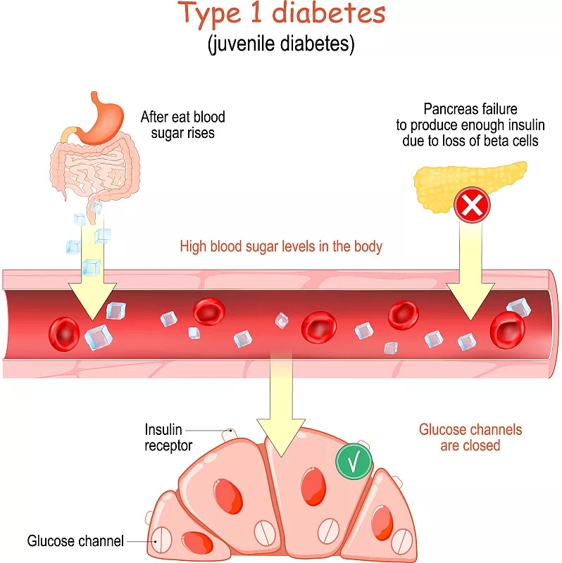 1型糖尿病癥狀有哪些? 1型糖尿病癥狀有哪些?