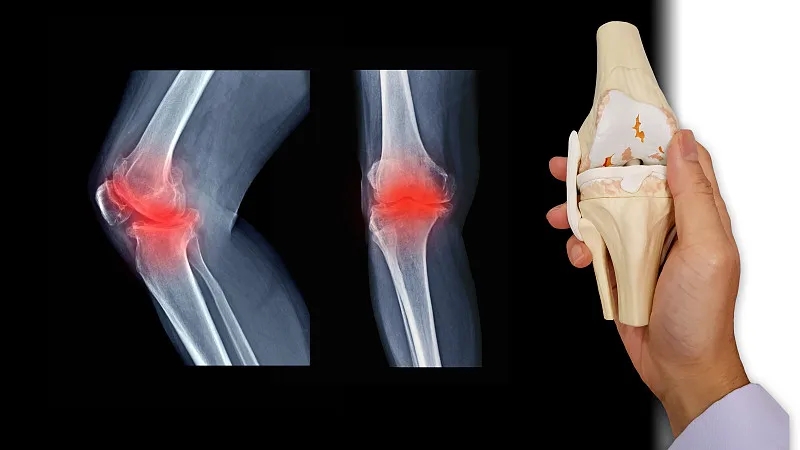 什么是骨關節炎-骨關節炎癥狀有哪些 什么是骨關節炎-骨關節炎癥狀有哪些