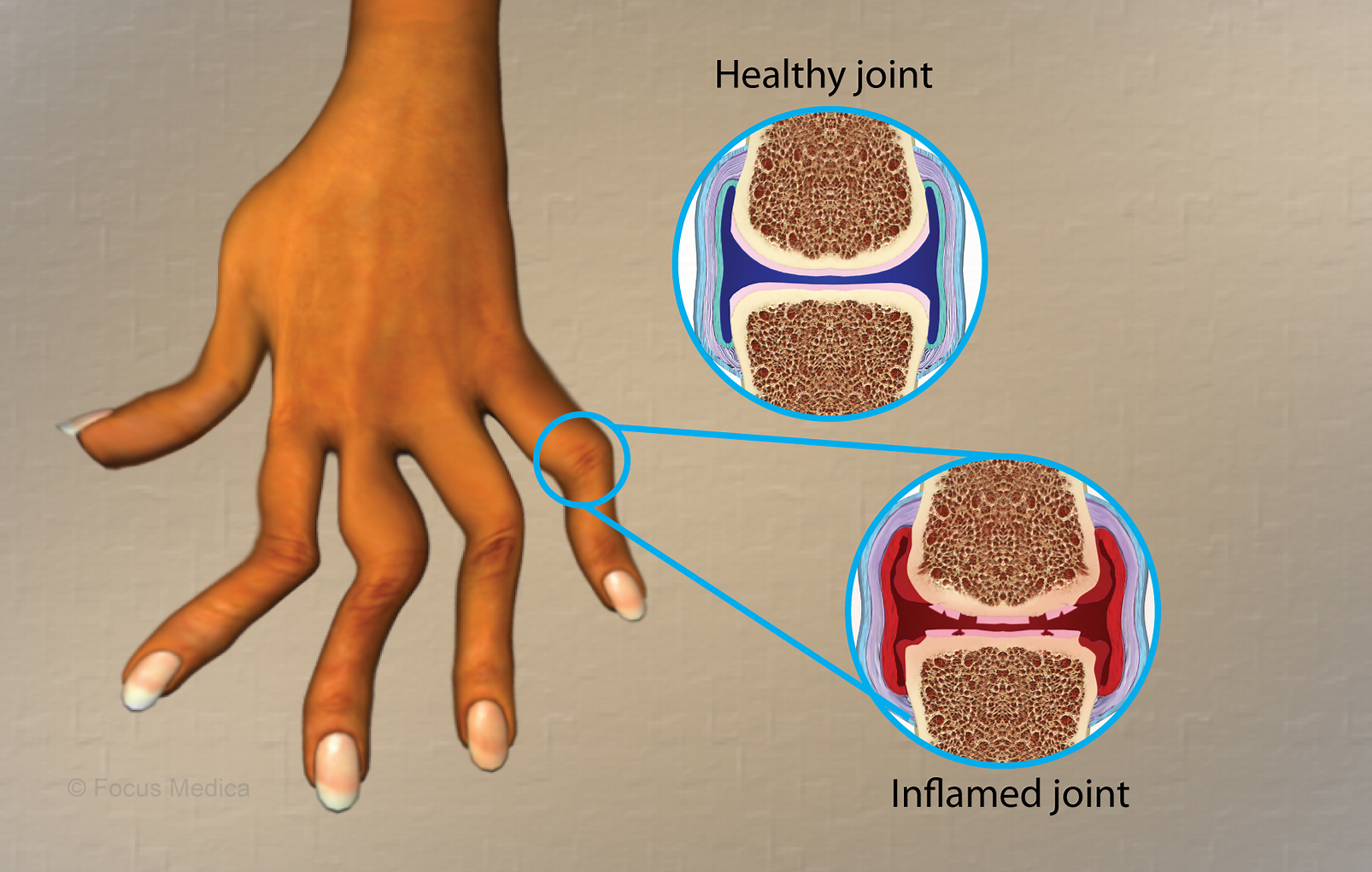 類風濕關節炎是什么病