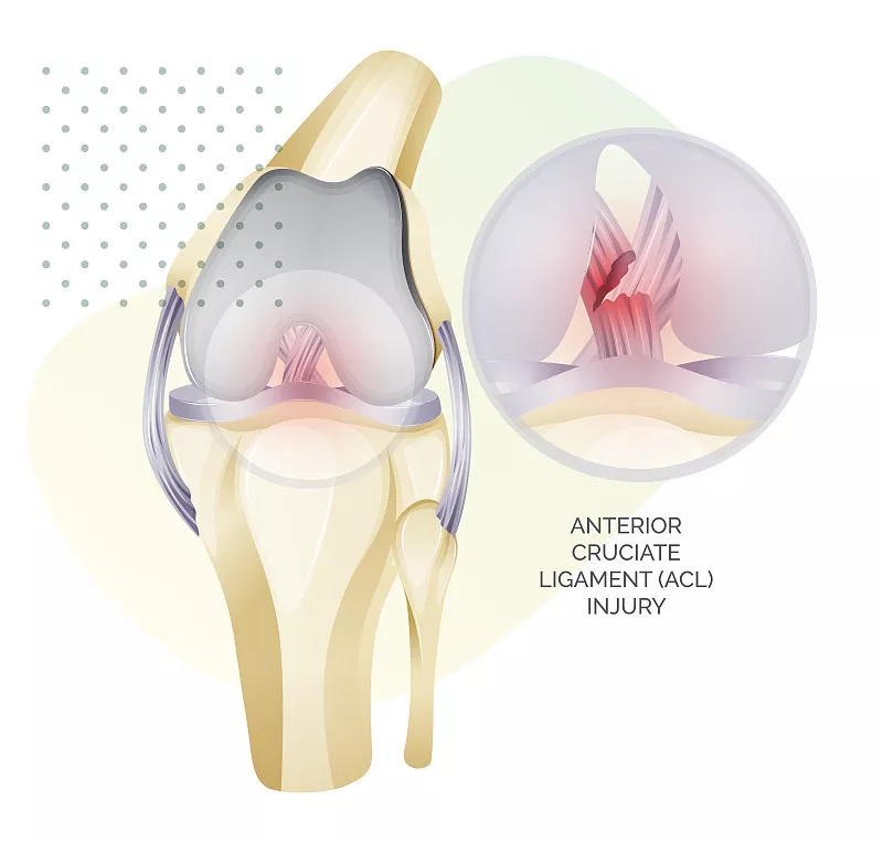 干細胞療法對半月板損傷的益處 干細胞療法對半月板損傷的益處