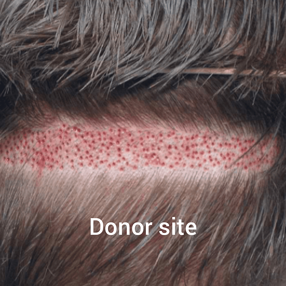 新技術(shù)的供體現(xiàn)場收獲試圖減少后部頭皮疤痕 新技術(shù)的供體現(xiàn)場收獲試圖減少后部頭皮疤痕