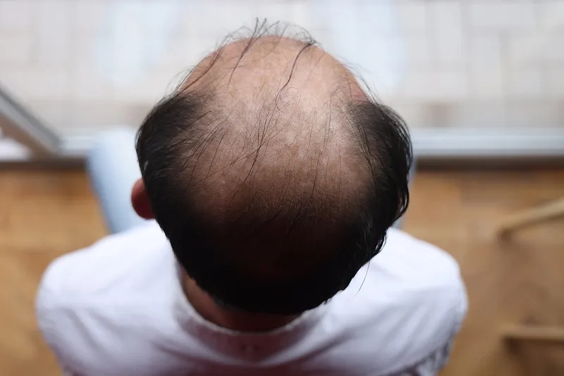 干細胞治療脫發的優缺點