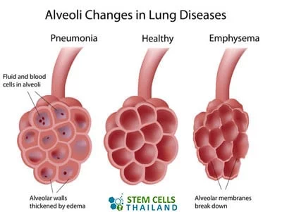 肺泡再生干細胞肺氣腫再生