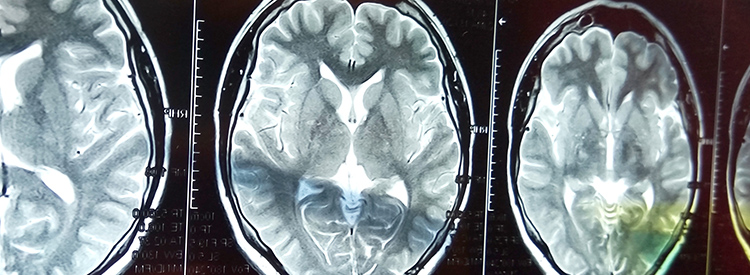 中風患者的干細胞治療