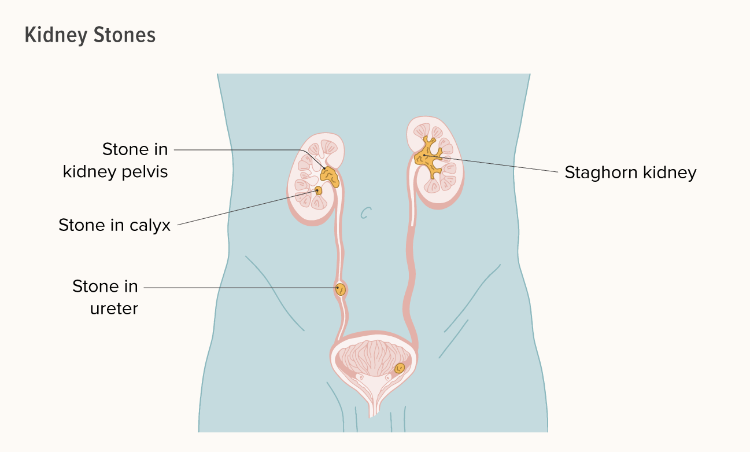 關于腎結石您需要知道的一切