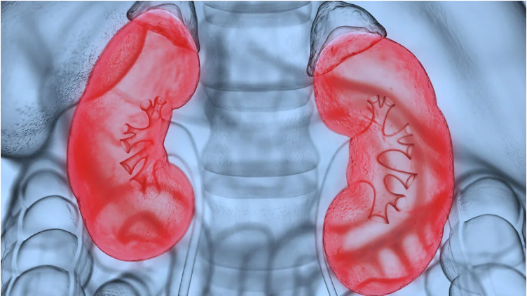 什么是腎病綜合征？癥狀和治療