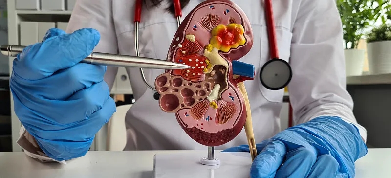 狼瘡的治療方法有哪些? 狼瘡的治療方法有哪些?