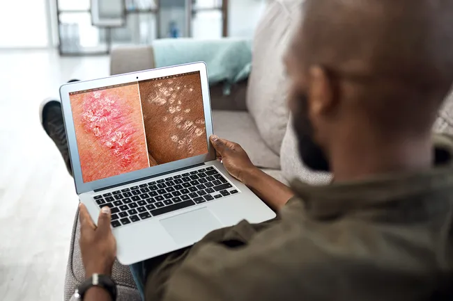 銀屑病的癥狀、類型和原因