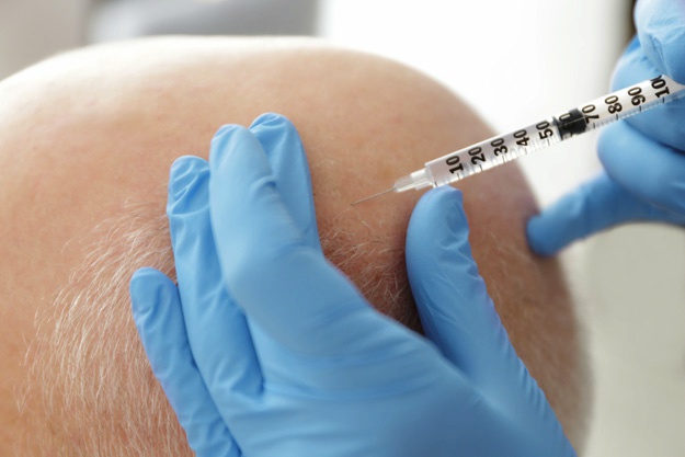 頭發(fā)修復(fù)過程是怎樣的？ |  干細(xì)胞治療脫發(fā)