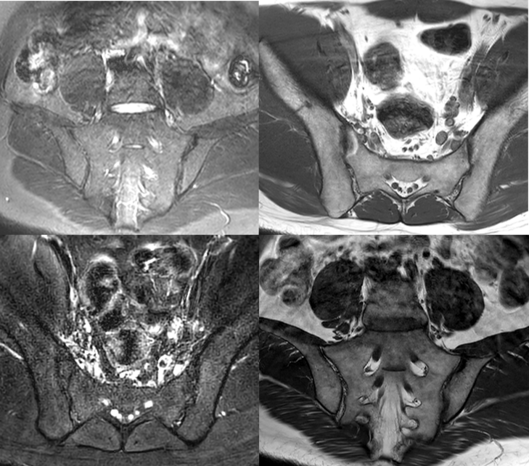 強直性脊柱炎是遺傳病嗎？