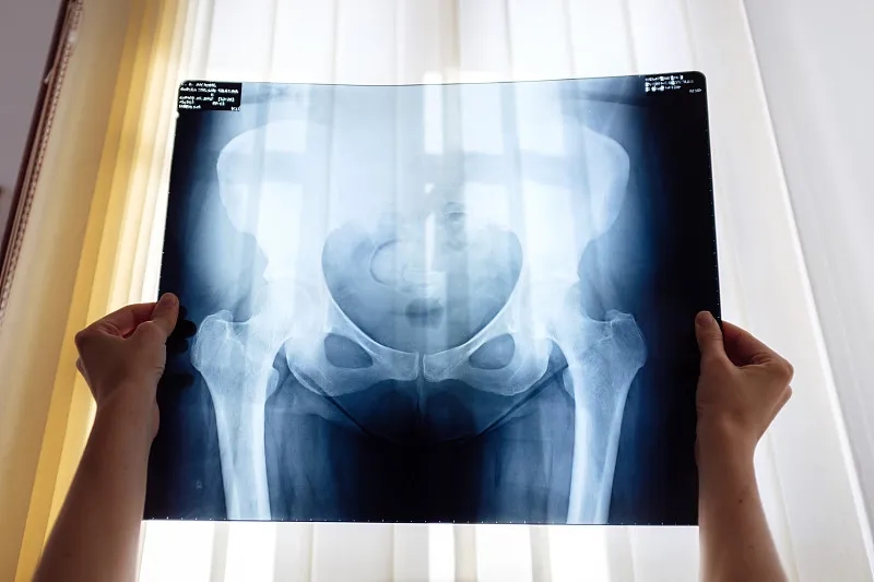 干細胞治療股骨頭缺血性壞死的臨床療效研究 干細胞治療股骨頭缺血性壞死的臨床療效研究