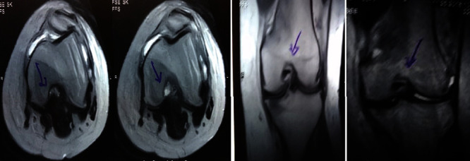 圖1:治療前MRI顯示內(nèi)側(cè)和外側(cè)半月板后角的III級(jí)撕裂。 圖1:治療前MRI顯示內(nèi)側(cè)和外側(cè)半月板后角的III級(jí)撕裂。