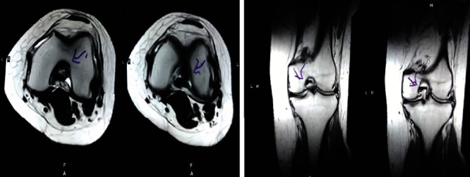 圖2:治療后MRI顯示內(nèi)側(cè)和外側(cè)半月板后角的撕裂有所改善。患者經(jīng)歷了癥狀改善以及進(jìn)行日常生活活動(dòng)的能力增強(qiáng)。 圖2:治療后MRI顯示內(nèi)側(cè)和外側(cè)半月板后角的撕裂有所改善。患者經(jīng)歷了癥狀改善以及進(jìn)行日常生活活動(dòng)的能力增強(qiáng)。