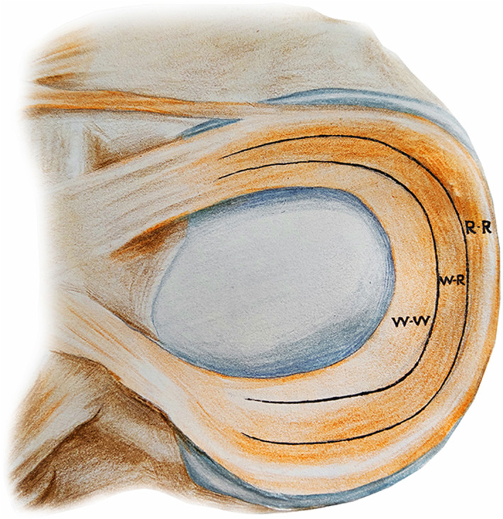 圖1：根據報告的血管分布，半月板的插圖展示了經典的三個區域