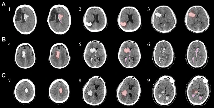 圖1：每個間充質干細胞治療患者按組的原始非對比計算機斷層掃描和分割結果