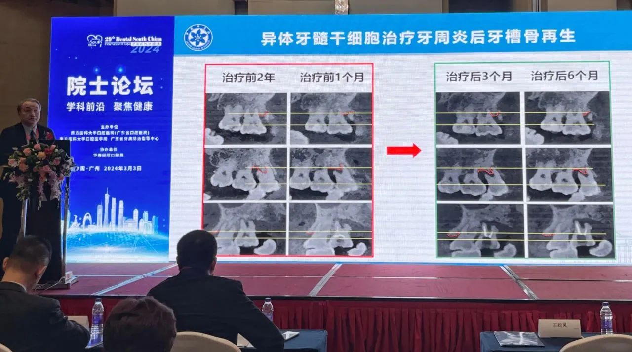 異體牙髓干細(xì)胞治療牙周炎后牙槽骨再生