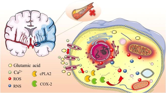 高血壓、高脂血癥、高同型半胱氨酸血癥、高血糖、吸煙和酗酒等危險(xiǎn)因素都可能引發(fā)缺血性中風(fēng)的發(fā)生。