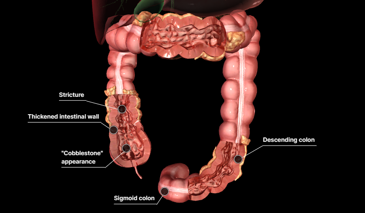 △克羅恩病3D圖示，來(lái)源：默沙東診療手冊(cè)