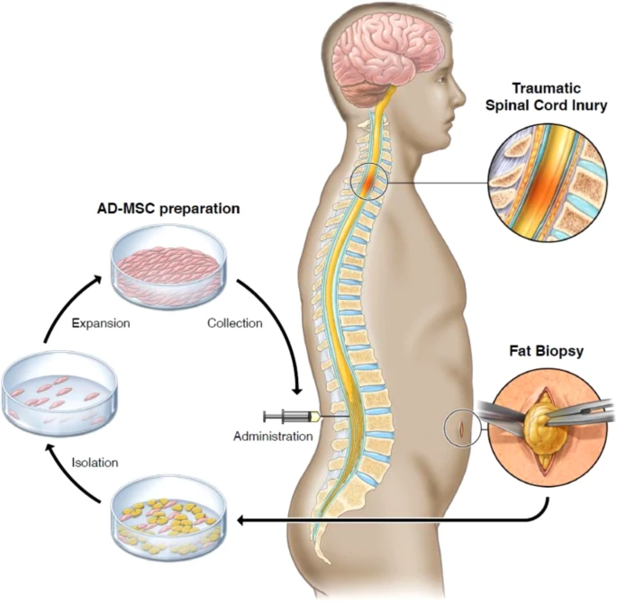 通過活檢、AD-MSC 分離、擴增和收集以及治療管理來獲取脂肪的過程圖解 通過活檢、AD-MSC 分離、擴增和收集以及治療管理來獲取脂肪的過程圖解