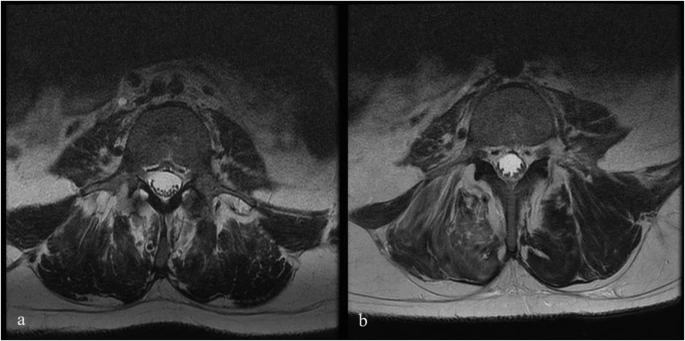 圖1:6號患者輸注前和輸注后MRI。 圖1:6號患者輸注前和輸注后MRI。