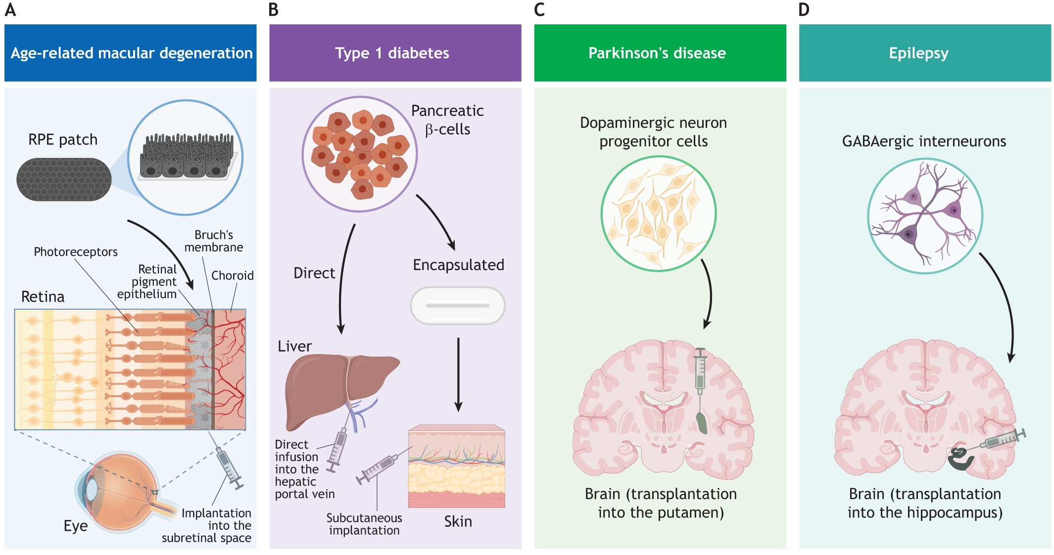圖2：使用hPSC衍生細胞產(chǎn)品進行開創(chuàng)性臨床試驗時所涉及的細胞類型和注射部位的圖示。