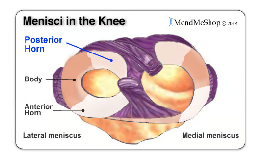 后角半月板撕裂癥狀、原因以及治療方法 后角半月板撕裂癥狀、原因以及治療方法