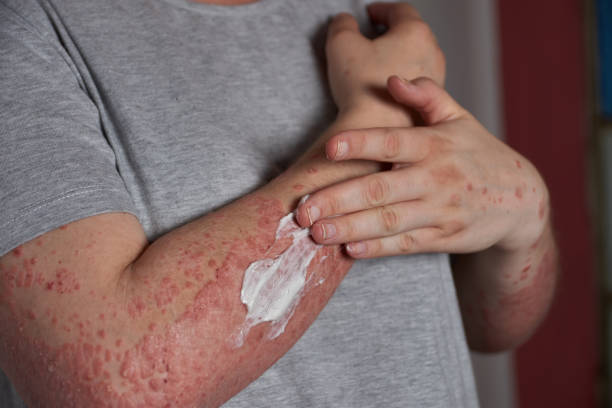 銀屑病的4類治療方式和用藥類型，你都清楚嗎？