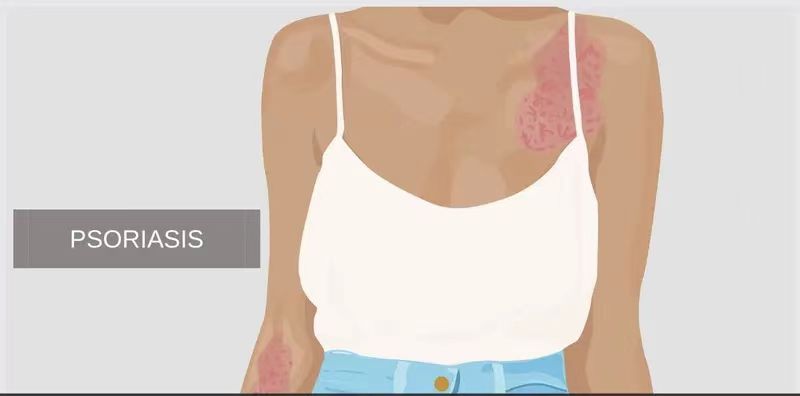 銀屑病的體征和癥狀是什么?及其治療方法 銀屑病的體征和癥狀是什么?及其治療方法