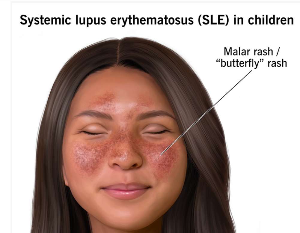 什么是兒童系統(tǒng)性紅斑狼瘡？及其病因和治療方法
