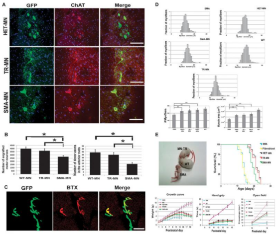 2012年干細胞治療脊髓性肌萎縮癥臨床案例