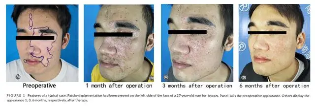 2023年干細(xì)胞治療白癜風(fēng)臨床案例 2023年干細(xì)胞治療白癜風(fēng)臨床案例