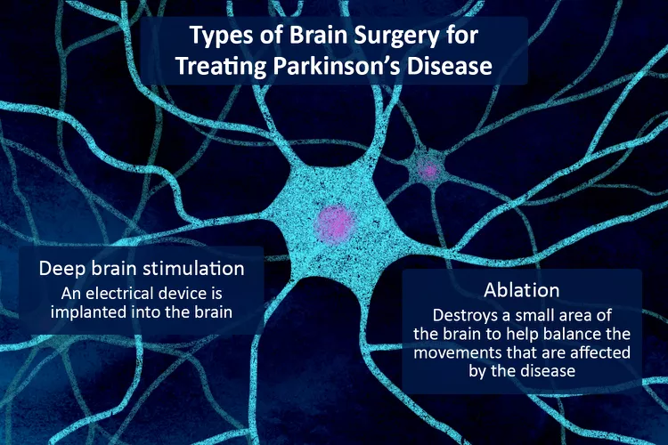 帕金森病的腦部手術：類型、恢復和風險