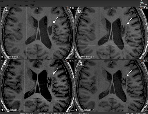 圖2:腔內(nèi)組織生長的縱向MRI示例。 圖2:腔內(nèi)組織生長的縱向MRI示例。