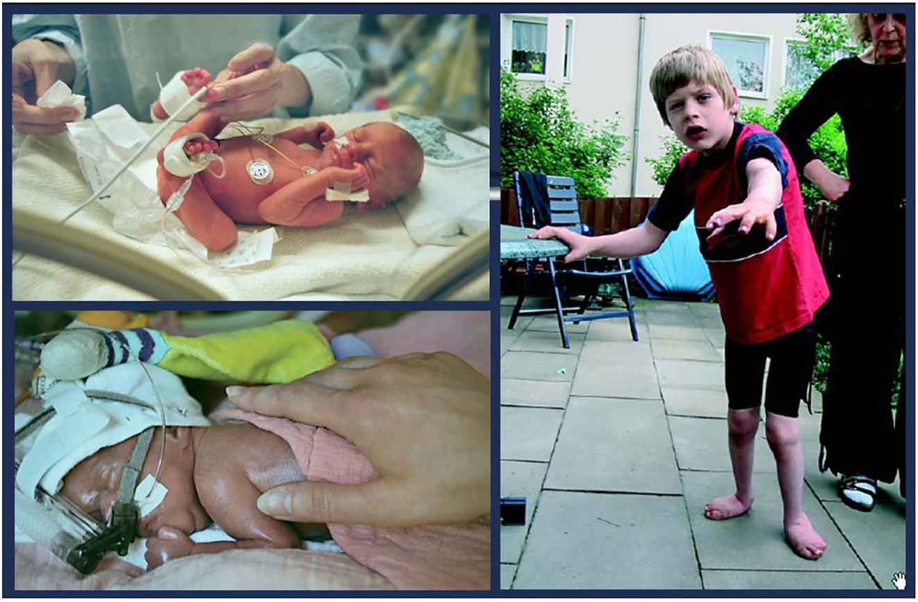 腦癱 (CP) 是兒童期最常見的殘疾，是一種嚴(yán)重的非進(jìn)行性嬰幼兒腦部疾病，具有終身后遺癥