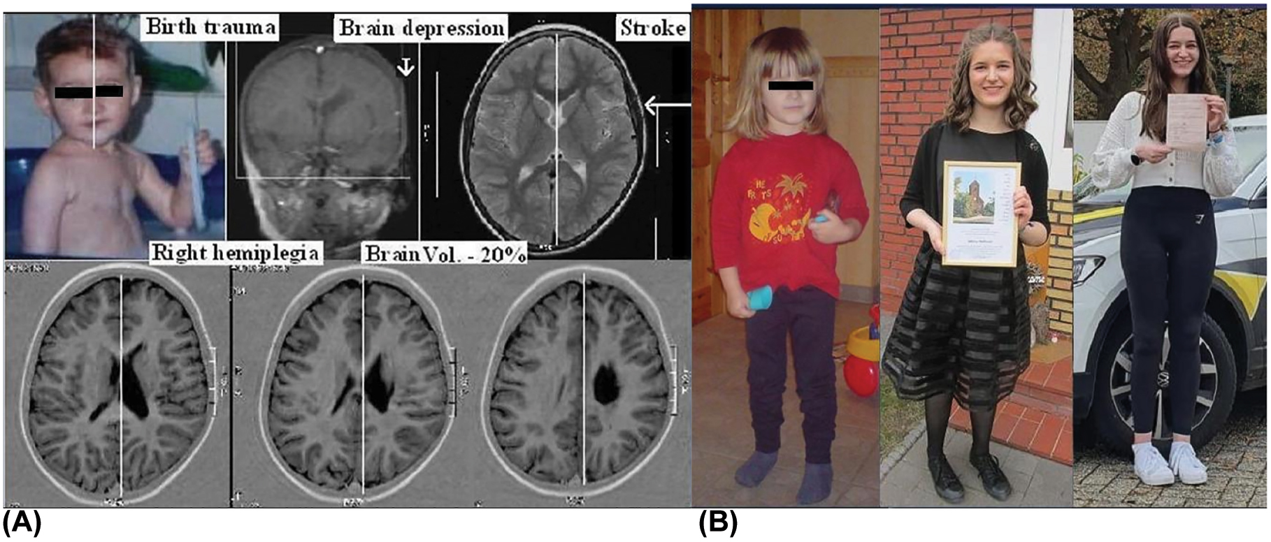 創(chuàng)傷是先天性腦癱的危險(xiǎn)因素