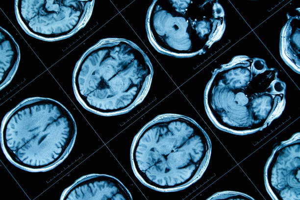 8.干細胞治療神經系統疾病