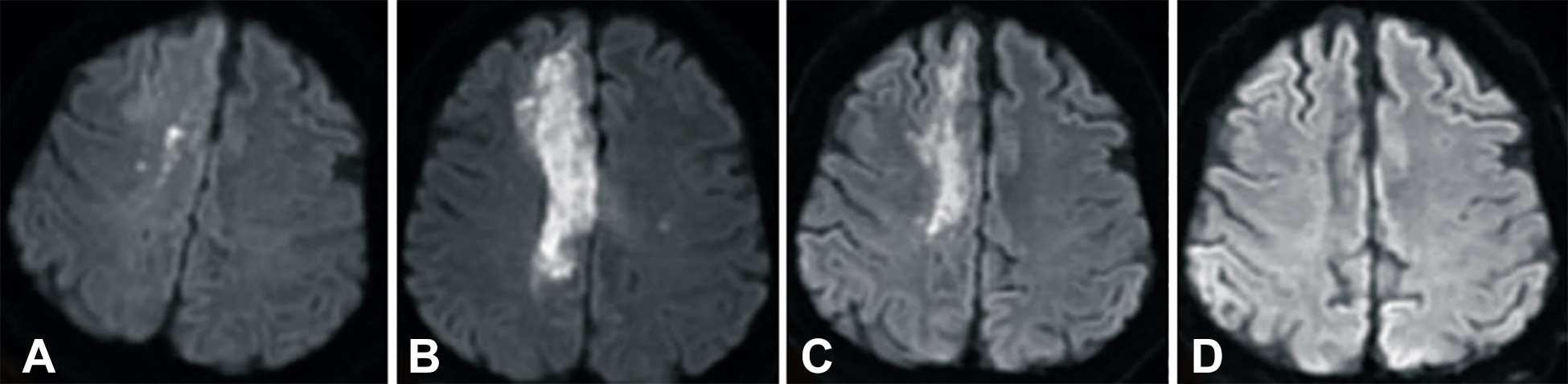 卒中發病后2小時和單核細胞臍帶血輸注后6個月獲得的彌散加權圖像