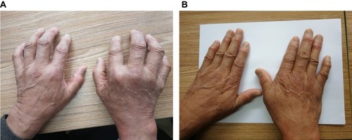 （圖1A）表現為雙手不能伸直。

（圖1B）治療3年后，停用抗風濕藥物5年，雙手伸展自如，關節周圍風濕結節逐漸變軟、消退。