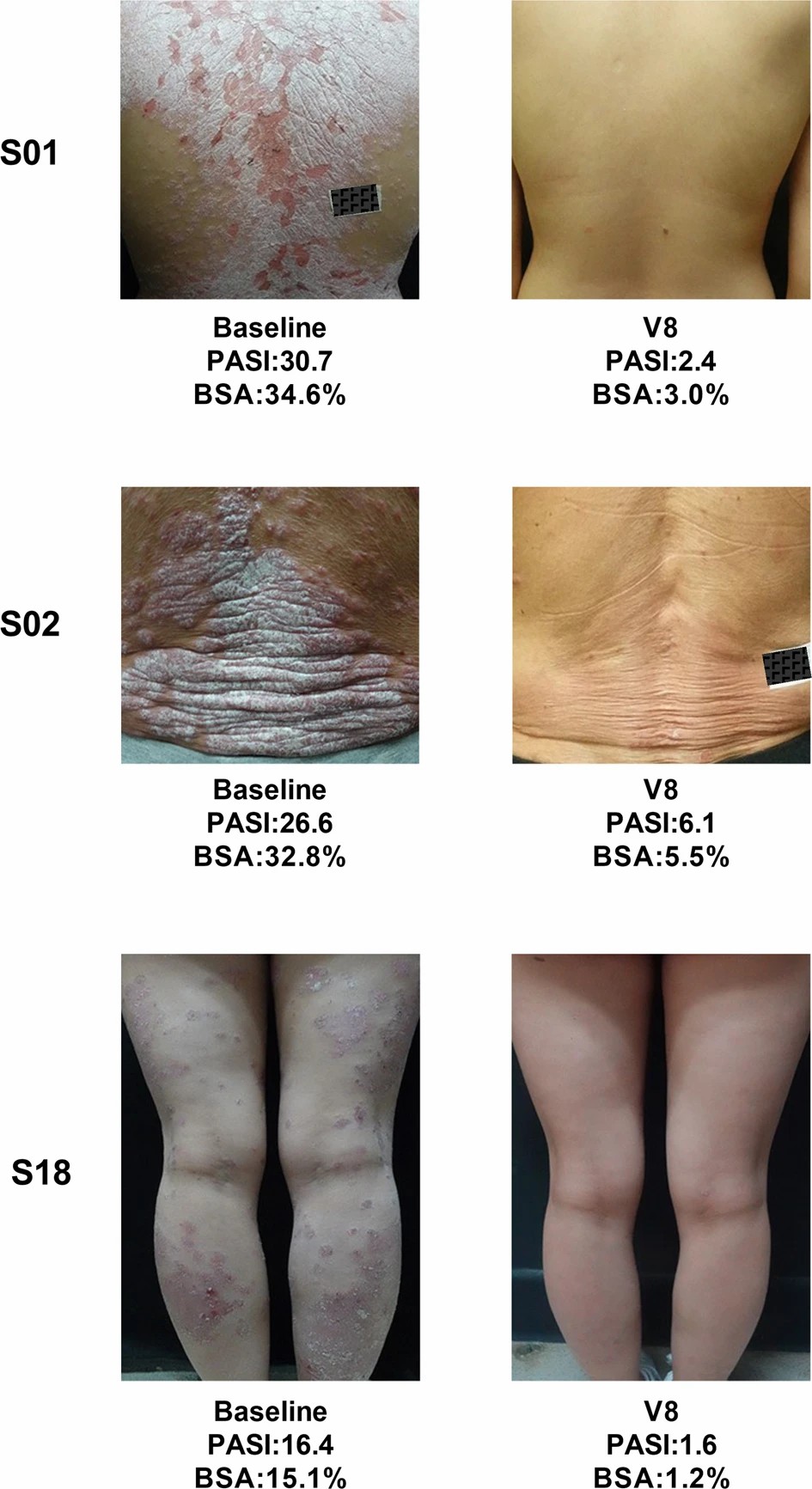三名患者經(jīng)過治療后根據(jù) PGA 評分顯示無疾病跡象（評分為 0）或輕微疾病（評分為 1）。
