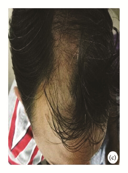 局部應(yīng)用骨髓間充質(zhì)干細(xì)胞一個月后，銀屑病消退，炎性紅斑完全清除（c）。