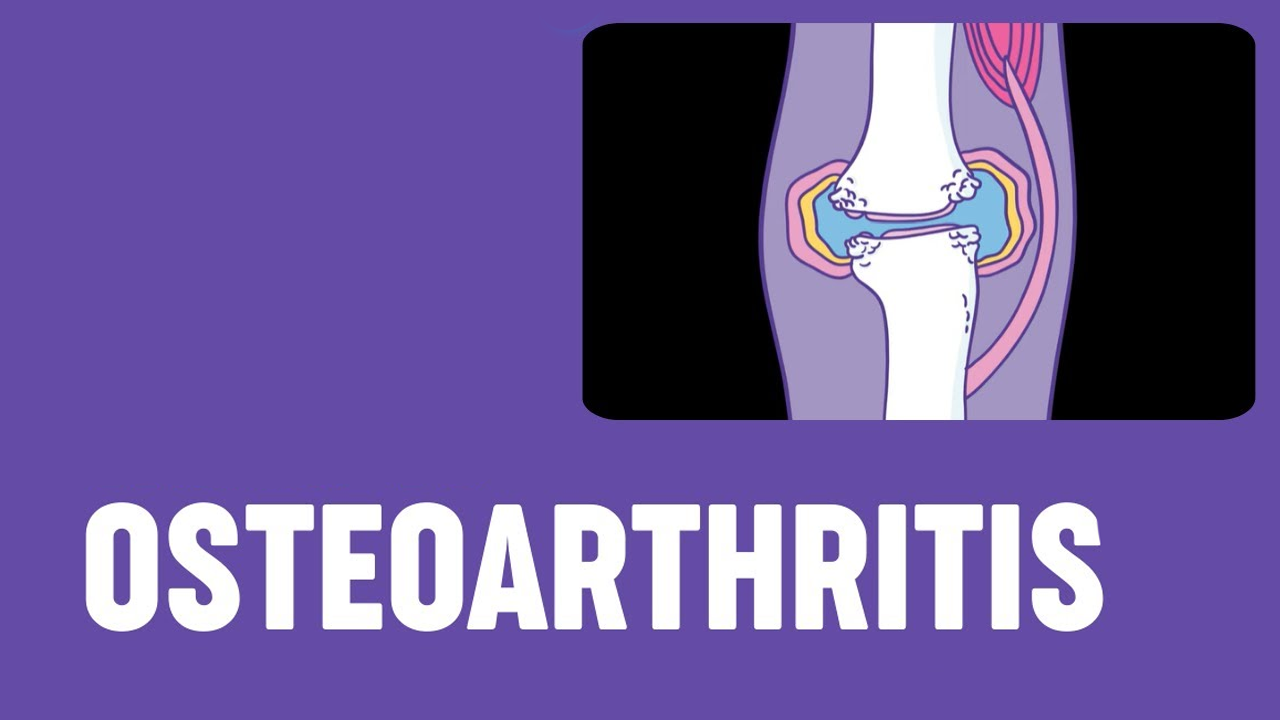 5項研究171例患者，評估干細胞治療骨關節炎的安全性和有效性