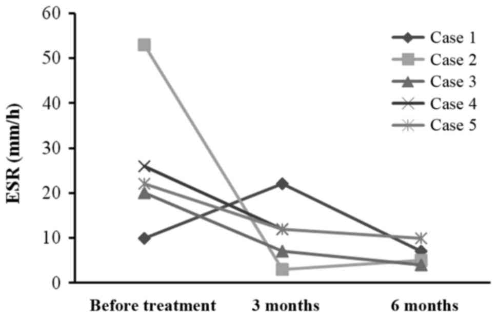 每位患者治療前后的 CRP 水平。1 名患者的 CRP 水平降低,而其他 4 名患者的 CRP 水平保持穩定并在正常范圍內。CRP,C 反應蛋白。 每位患者治療前后的 CRP 水平。1 名患者的 CRP 水平降低,而其他 4 名患者的 CRP 水平保持穩定并在正常范圍內。CRP,C 反應蛋白。