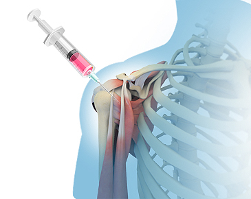 間充質干細胞需要注射幾次才會有效果?