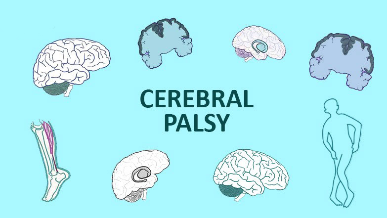 從步履蹣跚到穩健行走：干細胞技術如何重塑腦癱兒童平衡能力？