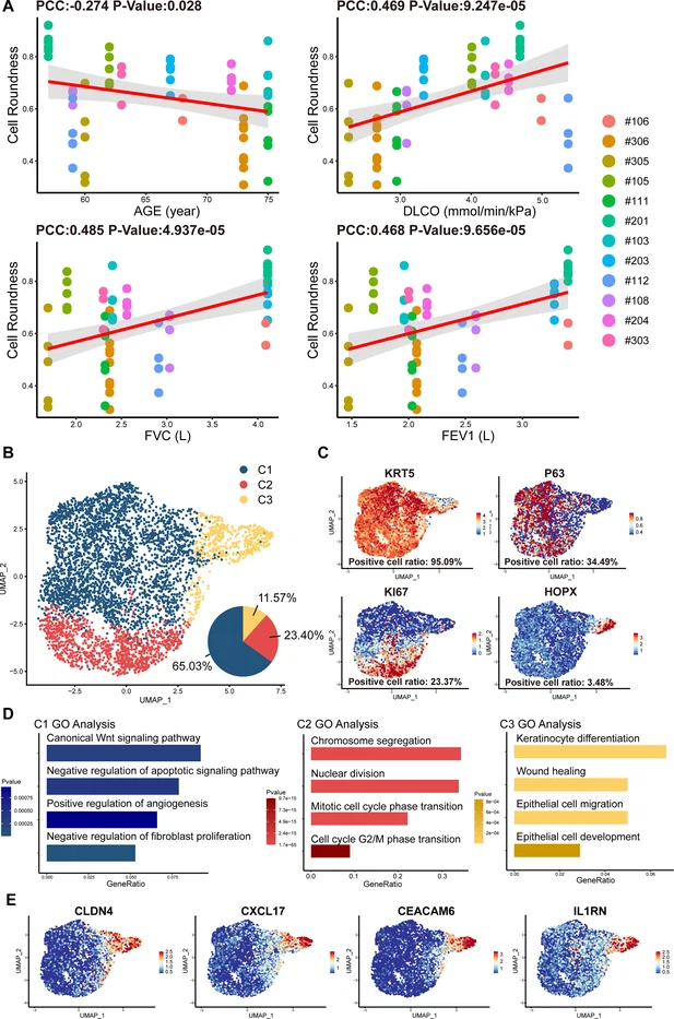 圖2:從IPF患者中分離的P63+肺祖細(xì)胞的細(xì)胞形態(tài)和單細(xì)胞RNA測序分析。 圖2:從IPF患者中分離的P63+肺祖細(xì)胞的細(xì)胞形態(tài)和單細(xì)胞RNA測序分析。