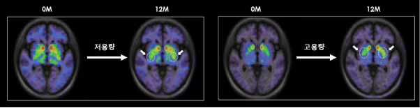 
低劑量和高劑量TED-A9植入一年后的腦成像。
